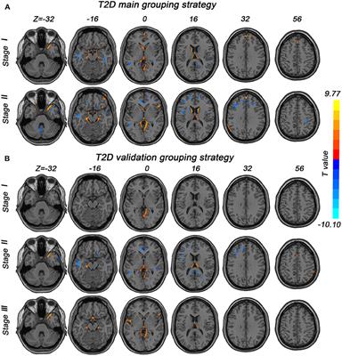 Causal Structural Covariance Network Suggesting Structural Alterations Progression in Type 2 Diabetes Patients